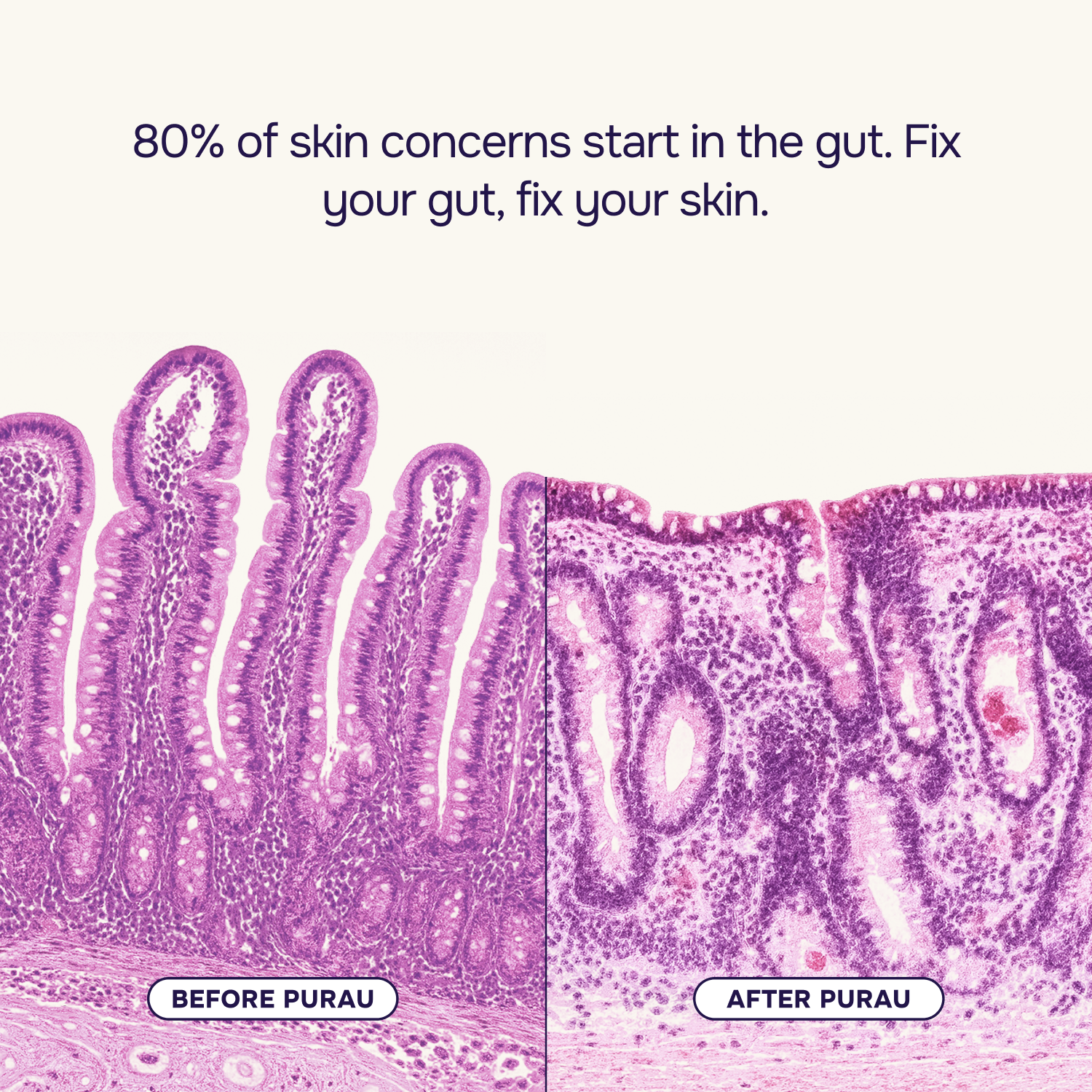 Advanced Acne Program™